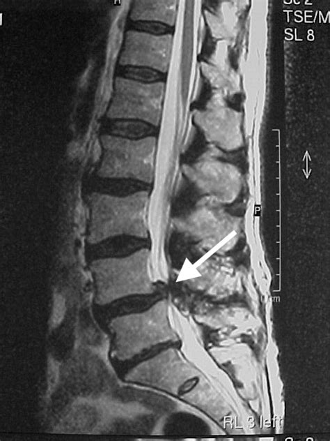 Degenerative Spondylolisthesis | Spine Surgeon