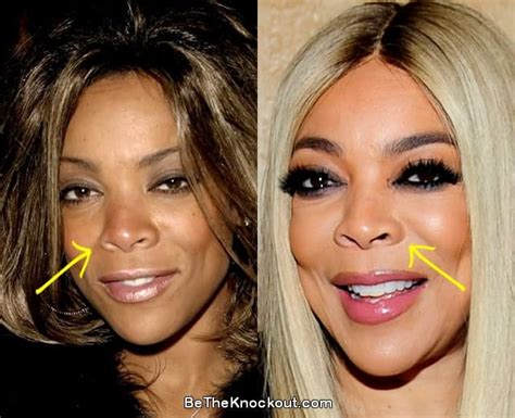 Wendy Williams Plastic Surgery Comparison Photos