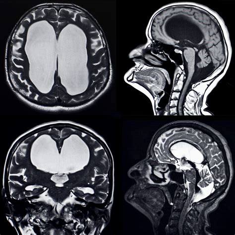 Hydrocephalus Mri