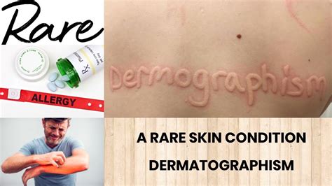 A RARE SKIN CONDITION | DERMATOGRAPHISM | CAUSES | TREATMENT | LIFE STYLE MODIFICATIONS - YouTube