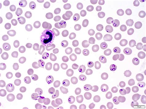 Pathology Outlines - Plasmodium falciparum