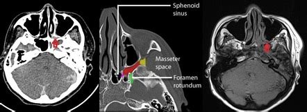 Pterygomaxillary fissure | Radiology Reference Article | Radiopaedia.org