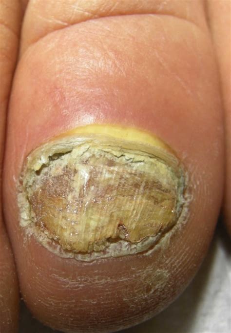 Onychomycosis causes, clinical appearance and onychomycosis treatment