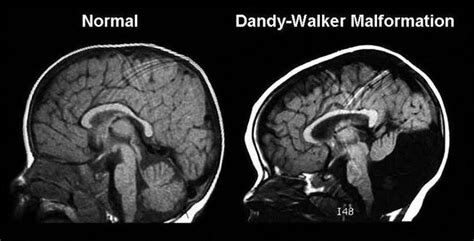 Dandy walker malformation - MEDizzy