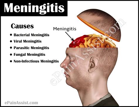 Meningitis: Treatment, Types, Causes, Transmission, Vaccine, Prevention