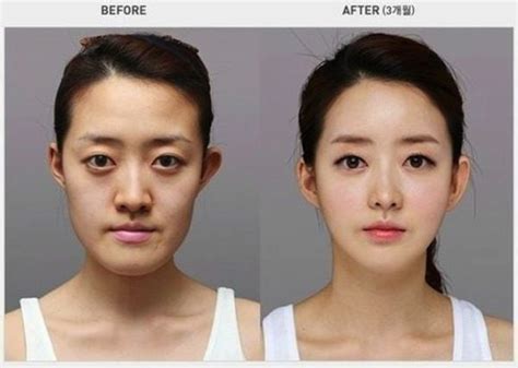 The 5 Best Plastic Surgery Clinics In Korea | Best Clinics for Eye & Nose Surgery, Facial ...