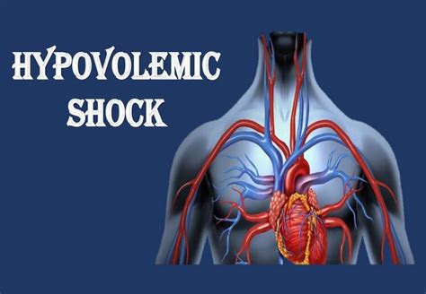 Hypovolemic Shock: Causes, Symptoms and Nursing Management