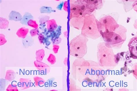 Epithelial Cell Abnormality: All You Need To Know - Papillex | Squamous ...