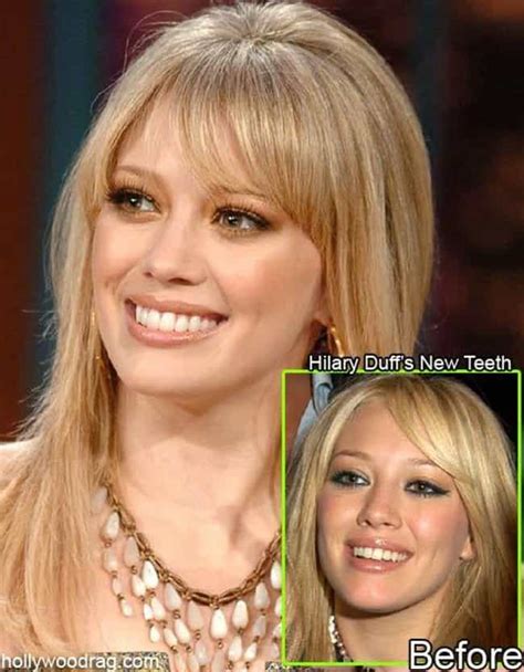 Celebrities with Fake Teeth | List of Famous People with Dentures and Dental Implants