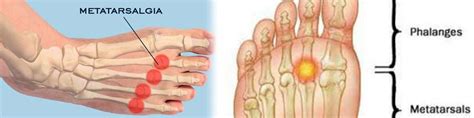 Metatarsalgia: Cause and Orthotics Treatments