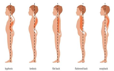 Flat Back Syndrome - EP Wellness & Functional Medicine Clinic