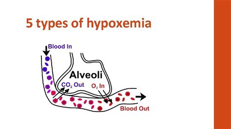 Acute Respiratory Failure 5 types of Hypoxemia John