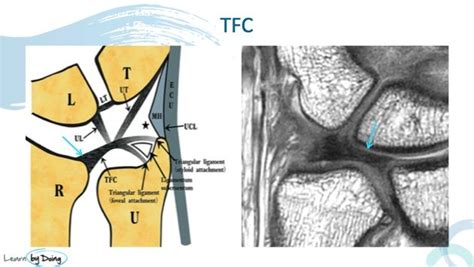 MRI Wrist TFCC Anatomy - Radedasia