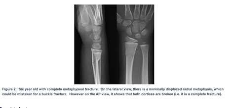 Greenstick Fracture X Ray