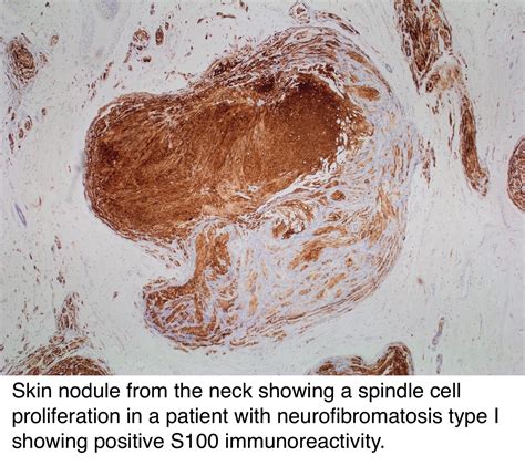 Pathology Outlines - Neurofibroma-general