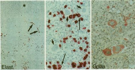 Case 3. Elastase: low power illustration on the left shows that the ...