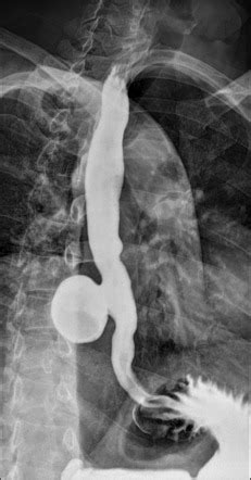 Epiphrenic Diverticulum