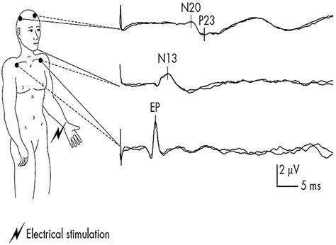 Somatosensory evoked potentials aid prediction after hypoxic–ischaemic brain injury | Practical ...