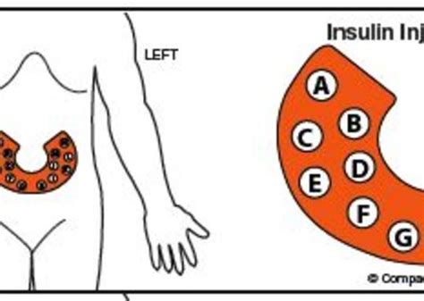 Insulin Injection Rotation Chart