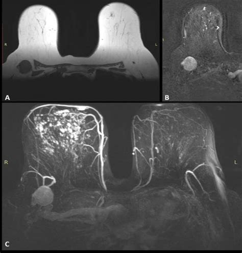 MRI shows: A) T1-weighted image shows a 4.0 cm, enlarged LN with loss... | Download Scientific ...