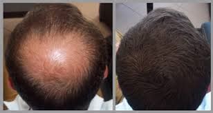 Biofibre Hair Transplant | Hair Loss Clinic in Glasgow