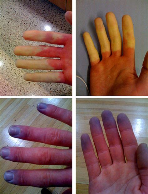 Raynaud Phenomenon Symptoms, Causes, Diagnosis, Treatment | Healthhype.com