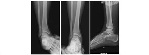 The varus and valgus stress views and anterior drawer view in X-ray 4 ...