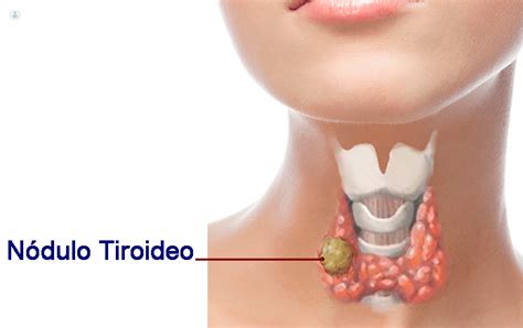 Nódulos Tiroideos: qué es, síntomas y tratamiento | Top Doctors