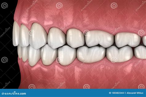 Two Chewing Side Teeth Of The Upper Jaw After Treatment Of Caries ...