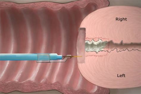 LEEP Conization Procedure on Vimeo