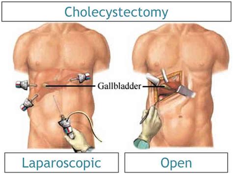 Cholecystectomy - Gallbladder Removal Surgery, Recovery, Side Effects