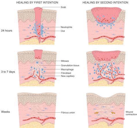 Regeneration healing (repair)-General Pathology Lecture note ...