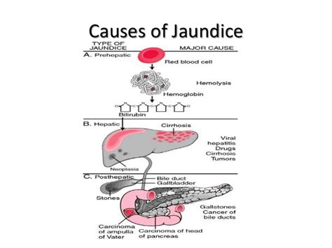 ASK DIS: Causes of Jaundice