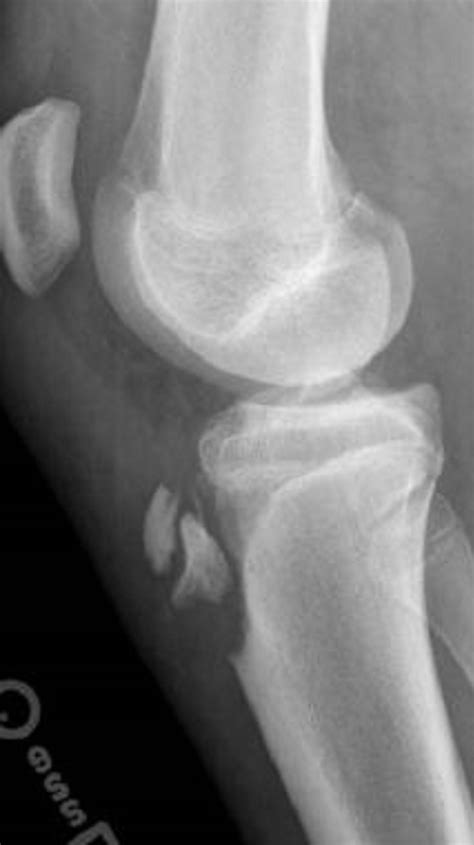 Tibial Tubercle Xray