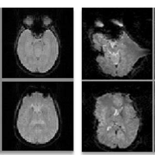 (PDF) Geometric distortion correction in EPI at ultra high field