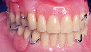 Dental Clasps; Denture Clasps