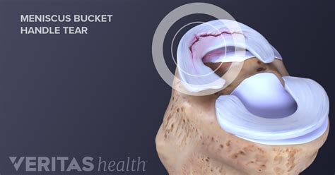 Symptoms of Meniscal Tears