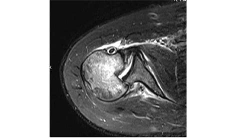 1st patient: MRI scan showing PSD, reverse Hill-Sachs, reverse Bankart... | Download Scientific ...