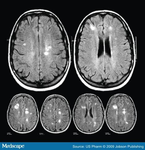 Mri Images Of The Brain With Multiple Sclerosis