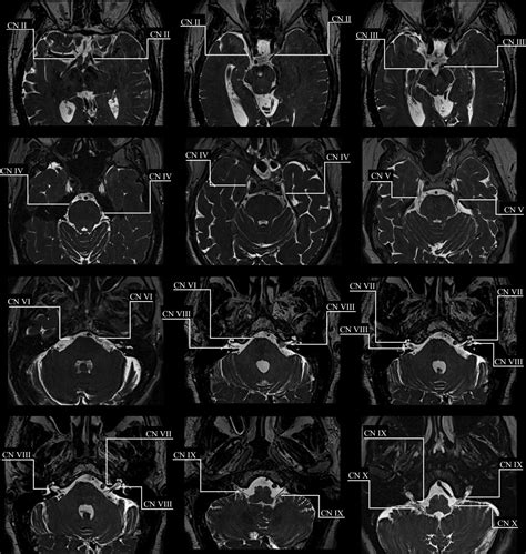 MRI sequence optimisation methods to identify cranial nerve course for radiotherapy planning - O ...