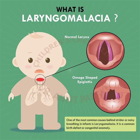 Tracheomalacia Newborn