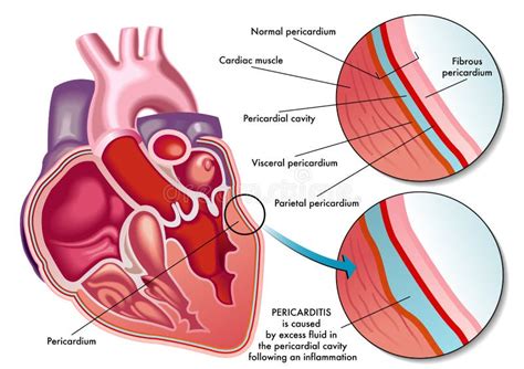 Pericarditis - Pictures