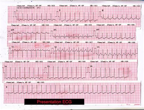 Psvt / Svt And Afib Cmwtfm Presents Fsm : Psvt is a fairly common type of abnormal heart rate.