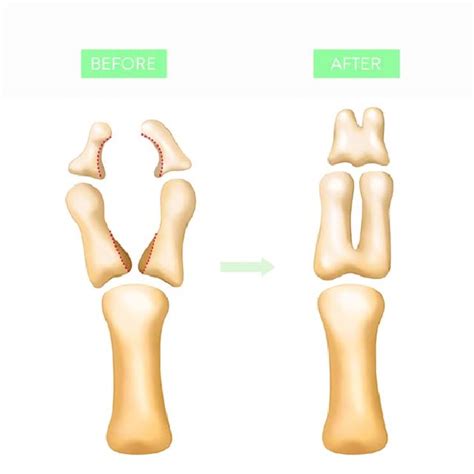 (PDF) A Modified Bilhaut–Cloquet Procedure for Zigzag Thumb Polydactyly Types III and IV