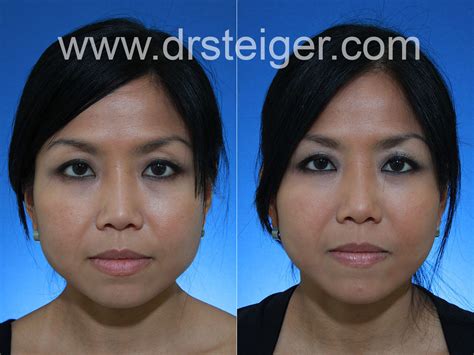 botox for jaw reduction | Steiger Facial Plastic Surgery | Boca Raton ...