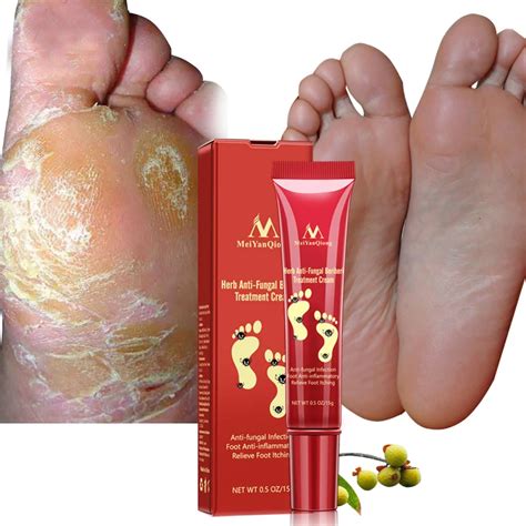 Beriberi paste Nail Treatment Onychomycosis Paronychia Anti Fungal Infection cuticle remover Toe ...