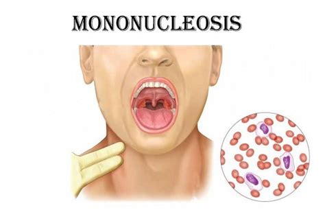 15 Early Warning Signs and Symptoms of Mononucleosis – Page 2 – New Life Ticket