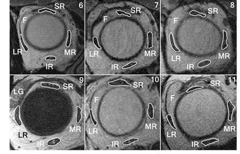 Heavy eye syndrome versus sagging eye syndrome in high myopia ...