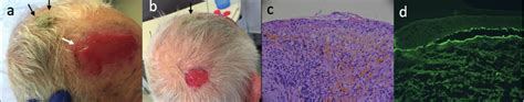 (a) Erosive plaque with excessive granulation tissue on the forehead in... | Download Scientific ...