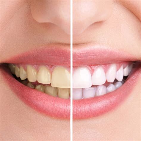 Best Teeth Whitening & Veneers Dentist | Cosmetic Dentistry Seattle